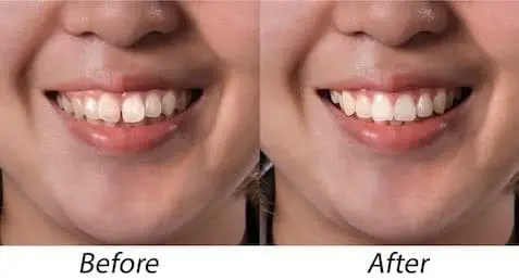 Teeth reshaping at Kapoor's Safe Hands Dental, Gurugram