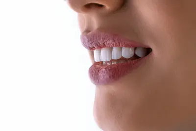 Teeth whitening at Kapoor's Safe Hands Dental, Gurugram